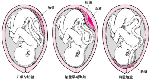 常位胎盤早期剥離 Placental abruption JapaneseClass.jp